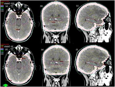 Feasibility of flattening filter free beams for hippocampal avoidance whole-brain radiotherapy: a dosimetric and radiobiological analysis